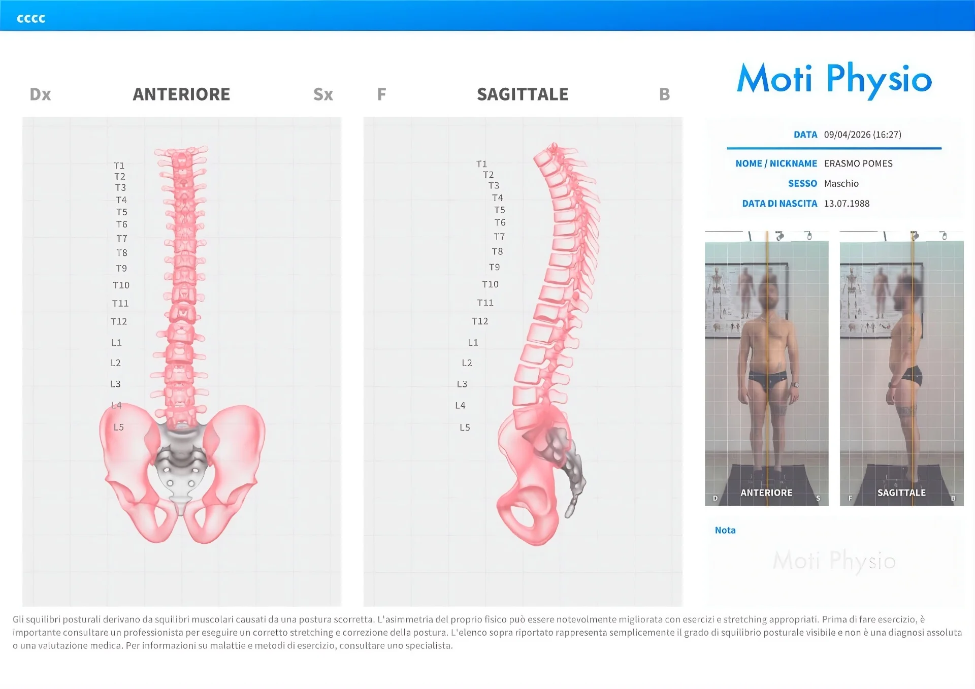 Report Moti Physio: analisi posturale 3D della colonna vertebrale, vista anteriore e sagittale